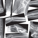 Broken Bones X-Ray Set of 15